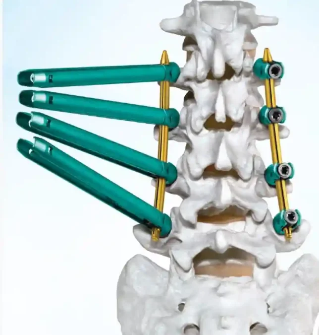 एम्स गोरखपुर का कमाल: पहली बार बिना बड़े चीरे के हुई स्पाइन सर्जरी, मरीज को मिला नया जीवन एम्स गोरखपुर का कमाल: पहली बार बिना बड़े चीरे के हुई स्पाइन सर्जरी, मरीज को मिला नया जीवन